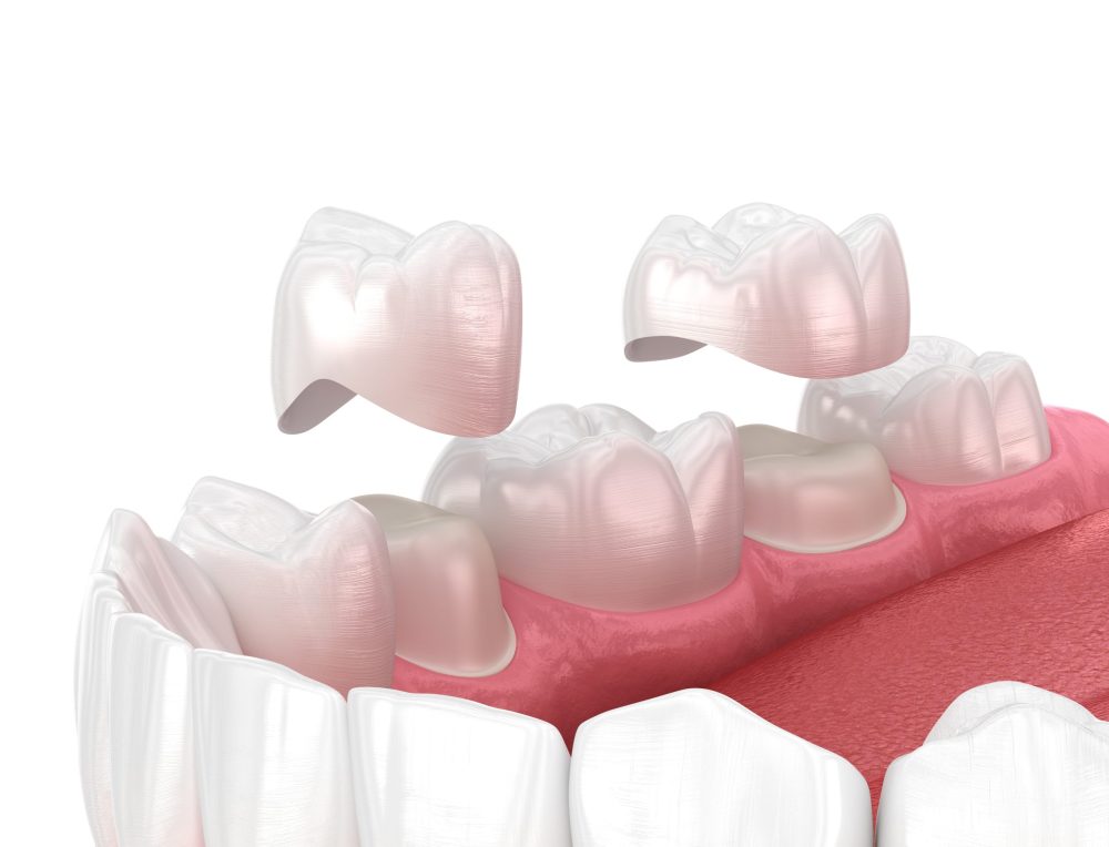 dental crowns Glendale