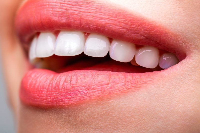 teeth whitening Glendale