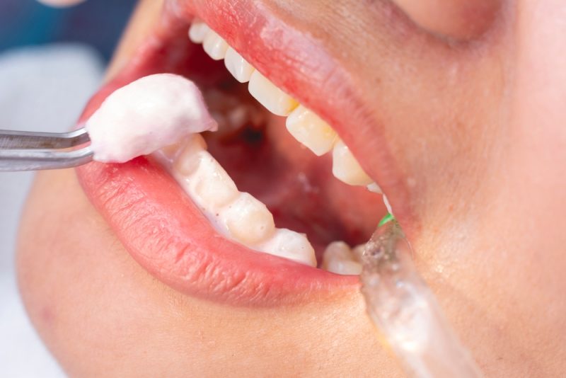 fluoride treatment Glendale
